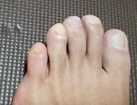 足の爪